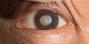 Cataracts eye